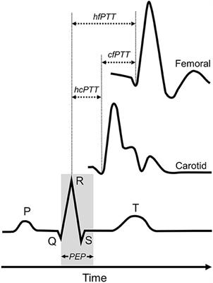 Acute Changes in Carotid-Femoral Pulse-Wave Velocity Are Tracked by Heart-Femoral Pulse-Wave Velocity